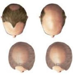 BALDNESS CLINIC